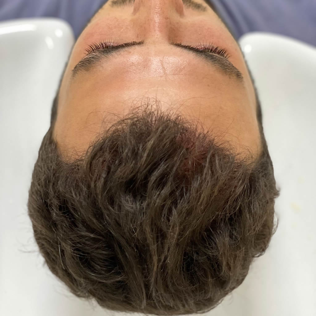 Hair Transplantation Turkey - Before and After