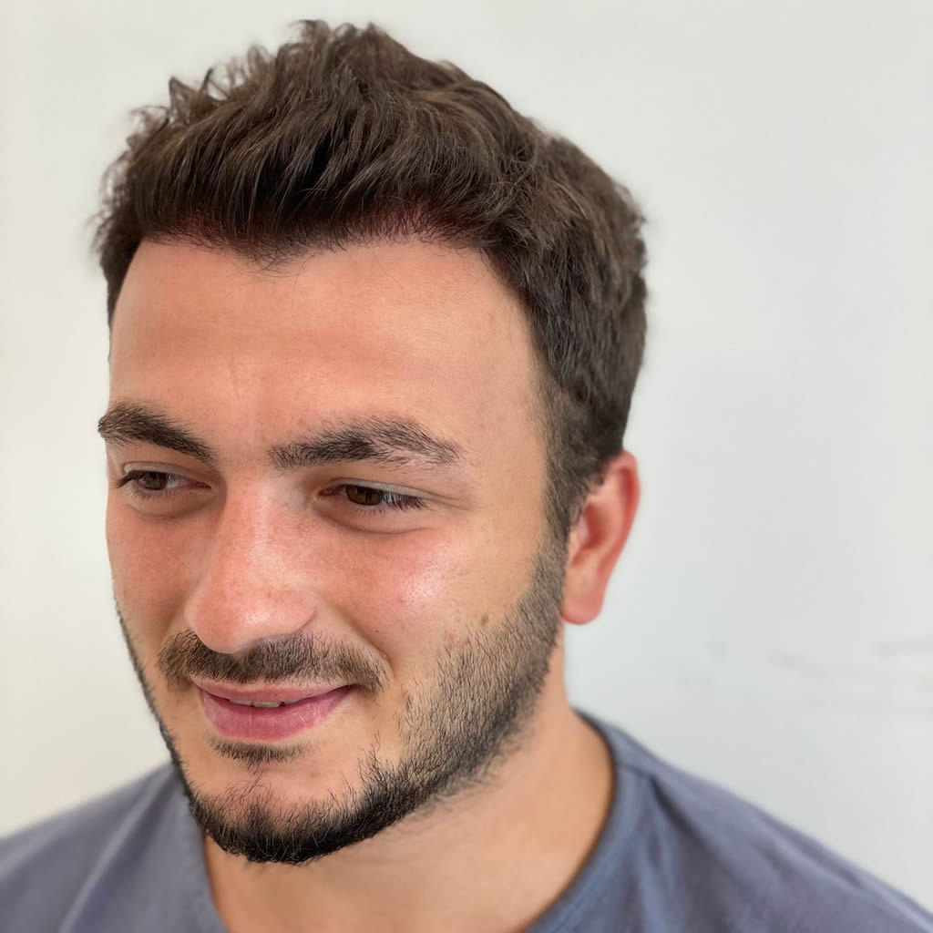 Hair Transplant in Turkey - Before and After