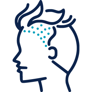 FUE Sapphire Hair Transplant