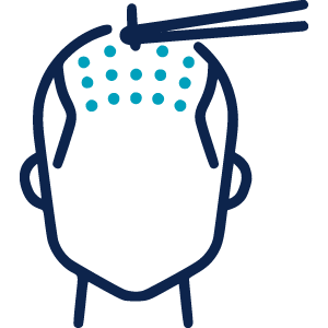 FUE Sapphire Hair Transplant