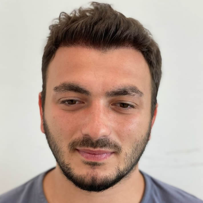 Hair Transplant in Turkey After Results