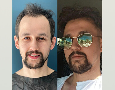DHI Hair Transplantation Procedure Clinics in Istanbul (4500 Graft) 