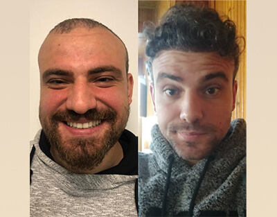 DHI Hair Transplantation Clinic in Turkey (4500 Graft) 