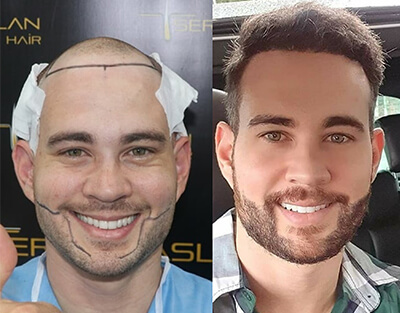 FUE Sapphire Hair Transplant Clinic in Turkey (4200 Graft) 