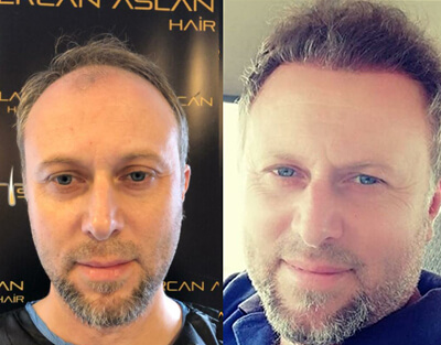 FUE Sapphire Hair Transplantation Procedure in Turkey (5000 Graft) 