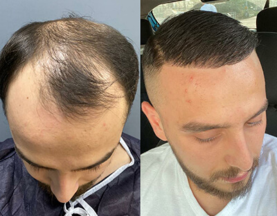 FUE Hair Transplant Clinic in Turkey (5500 Graft) 
